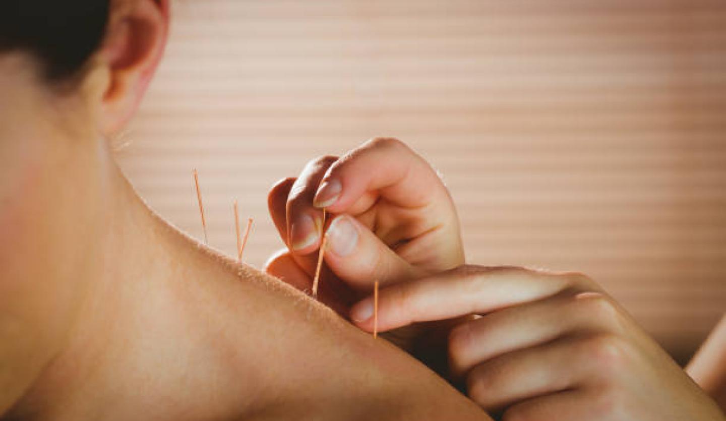 Acupuncture